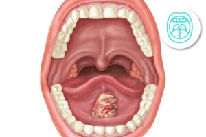 Biopsia de cavidad oral