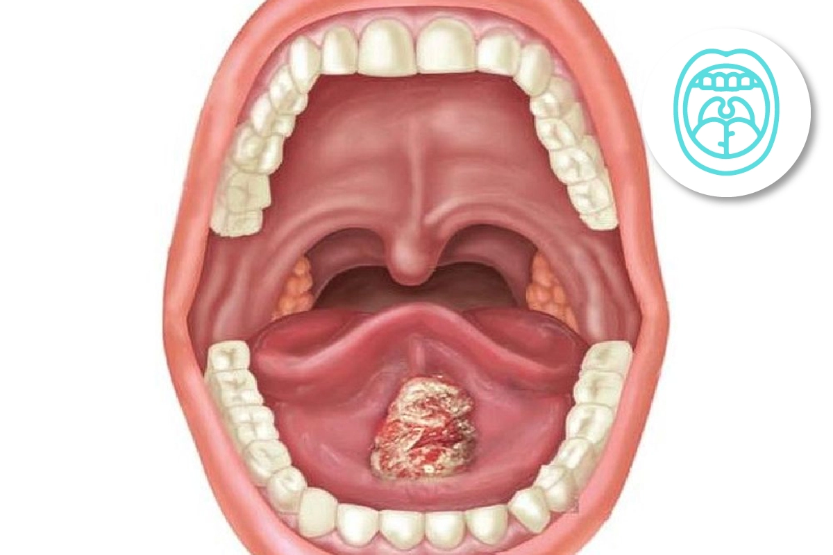 Procedimientos para el tratamiento y diagnóstico: Biopsia de cavidad oral